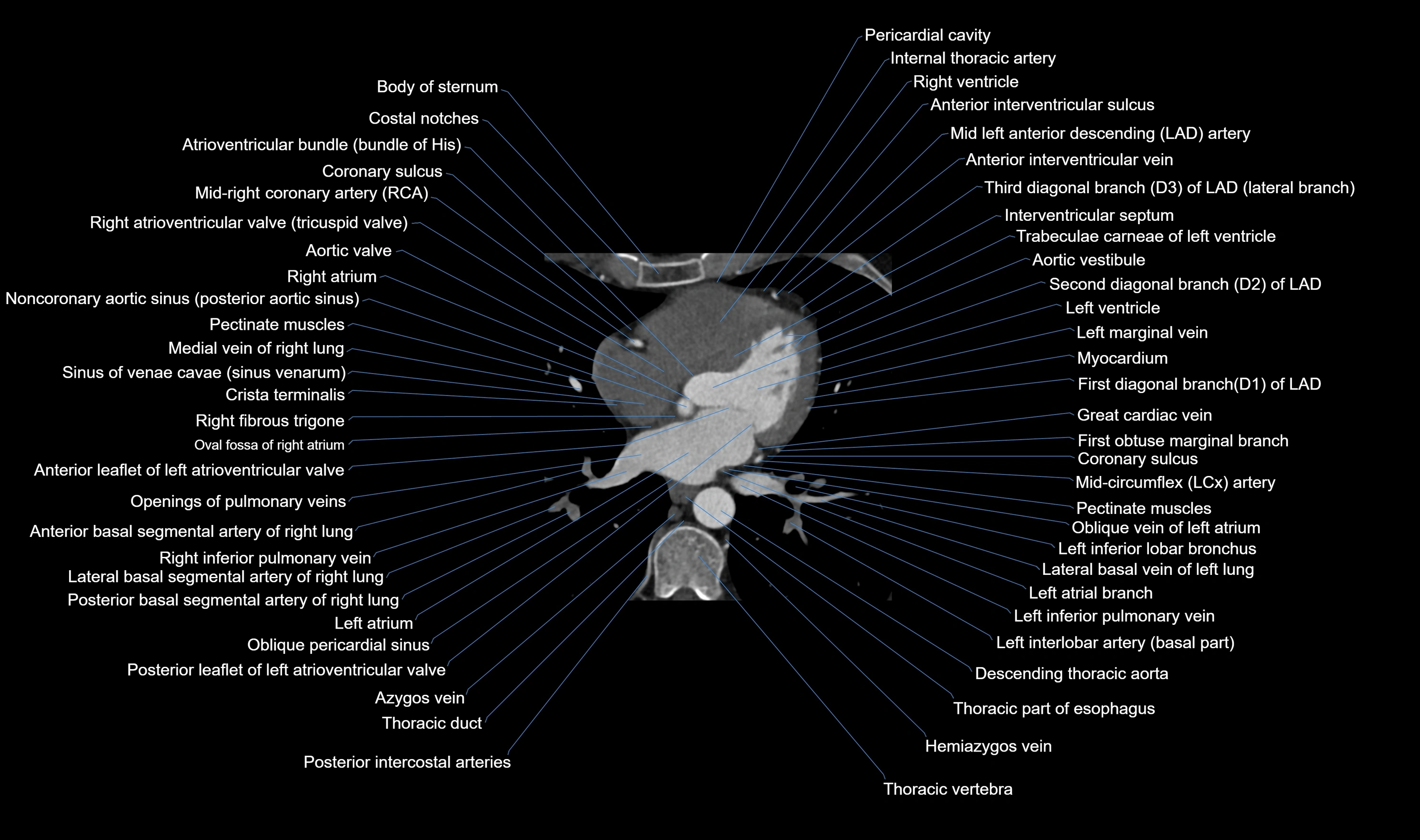 CT heart (coronary angiogram) axial view cross sectional anatomy labelled radiology image-00035.webp